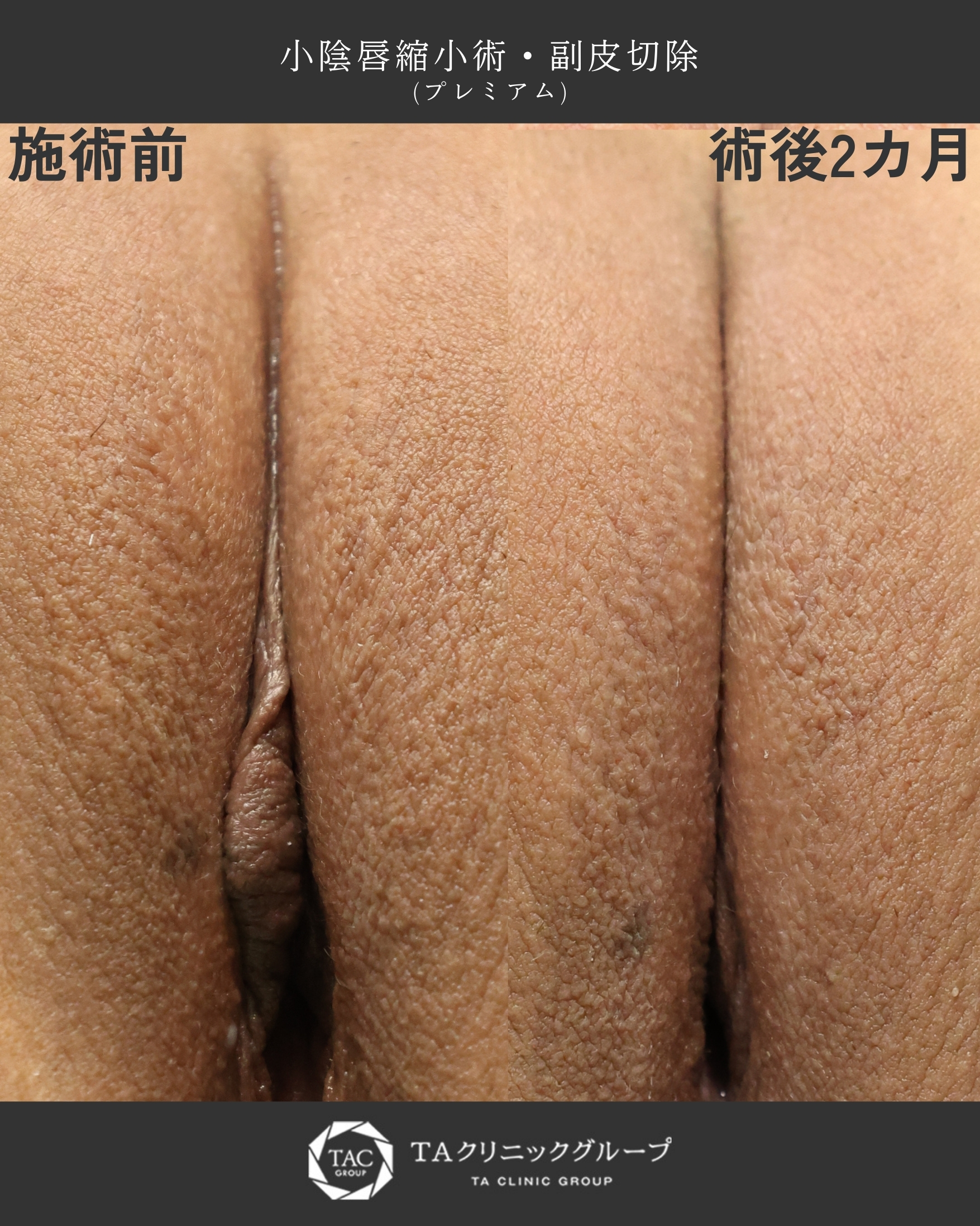 【小陰唇縮小術】片側だけのはみ出しと黒ずみが気になって…