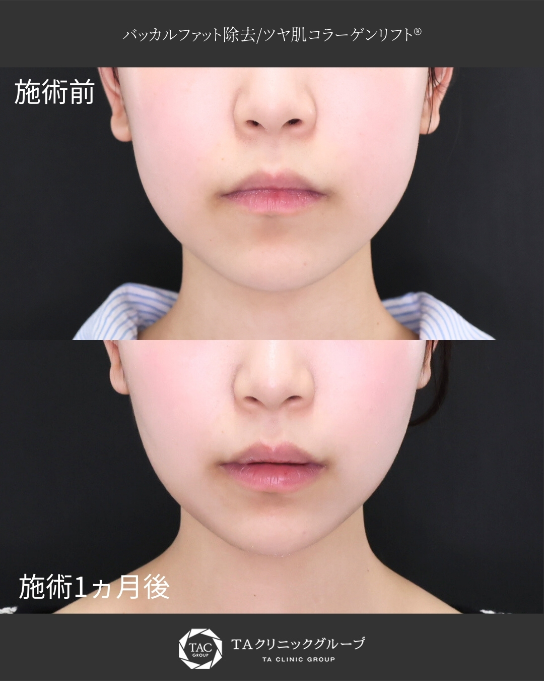 【バッカルファット除去】｜顔の余白感を減らして垢抜け輪郭へ