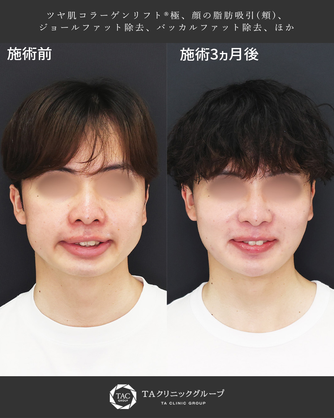 20代男性のバッカルファット除去｜笑った時の広がる輪郭を改善