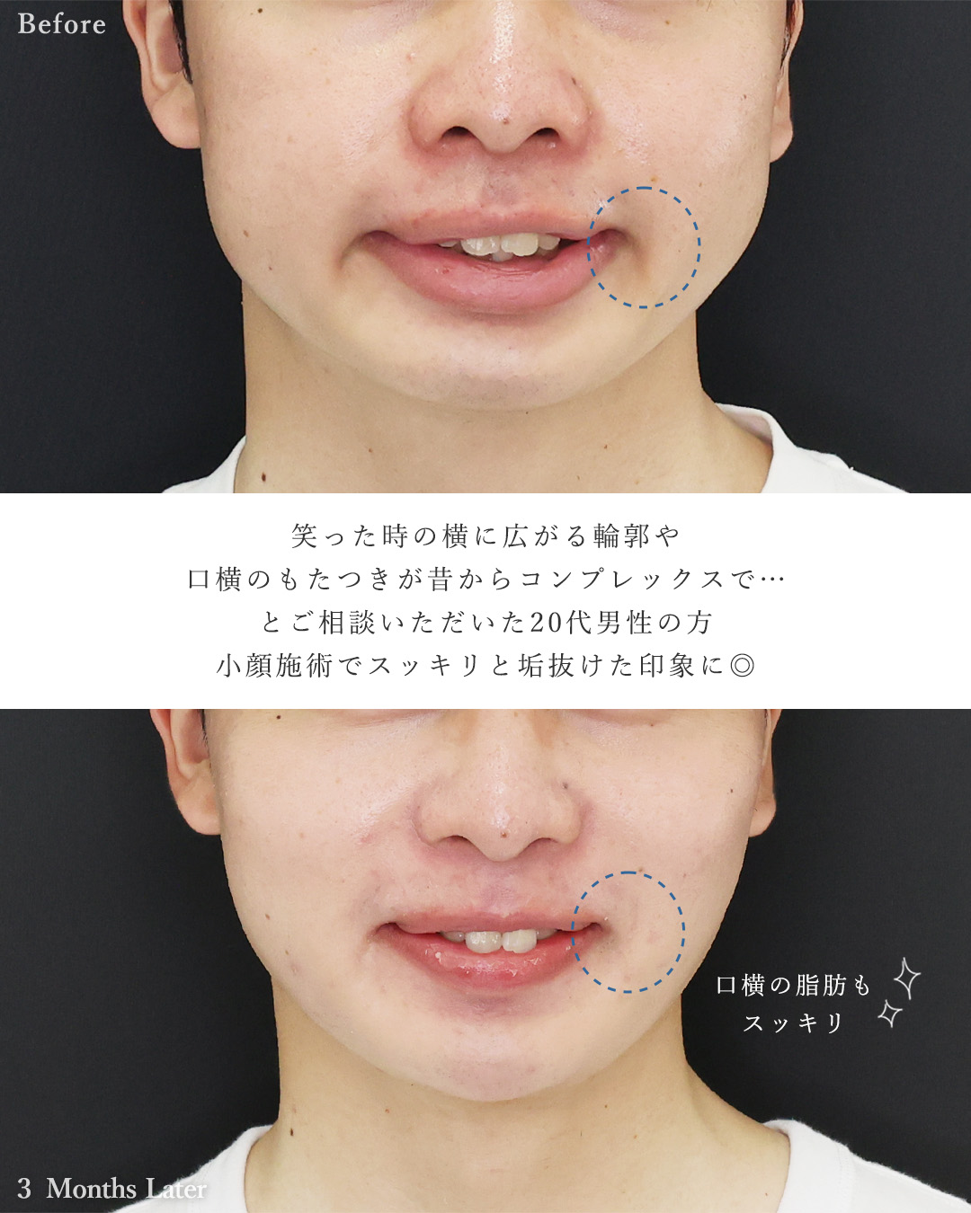 バッカルファット除去/ジョールファット除去/顎下の脂肪吸引・顔の脂肪吸引の症例写真 施術前後 