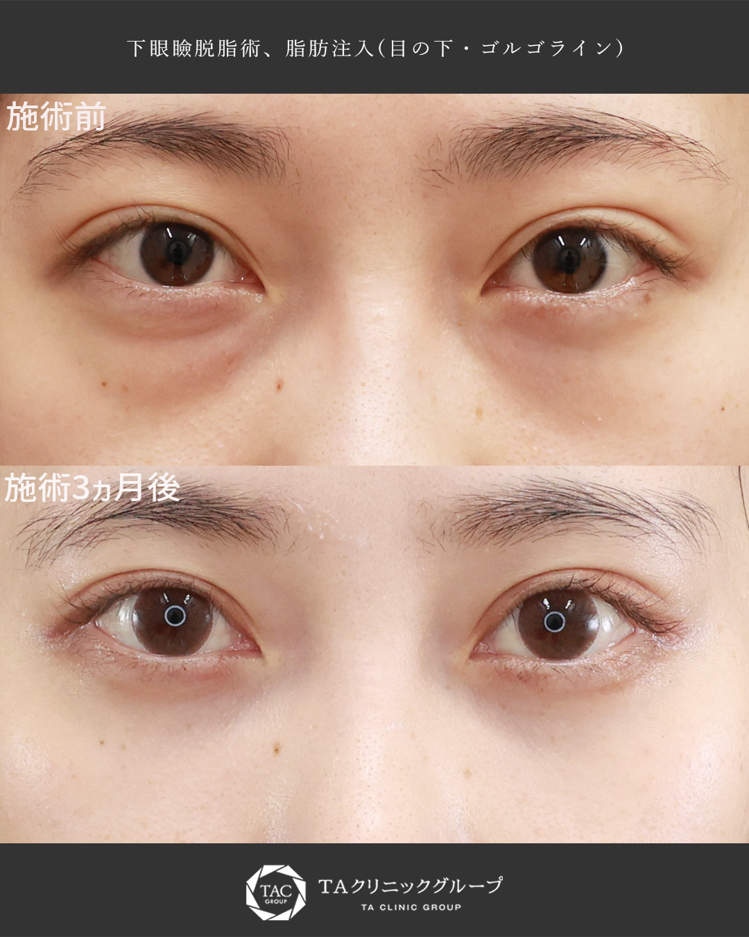 【20代女性】目の下のクマ取り（下眼瞼脱脂＋脂肪注入）｜疲れ見えを改善し明るい目元へ