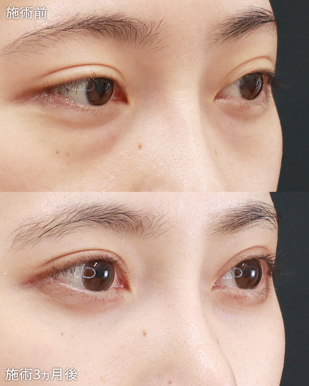 下眼瞼脱脂術（目の下のたるみ取り・目の下の脂肪ふくらみ取り）/顔の脂肪注入(コンデンスリッチフェイス)の症例写真 施術前後 