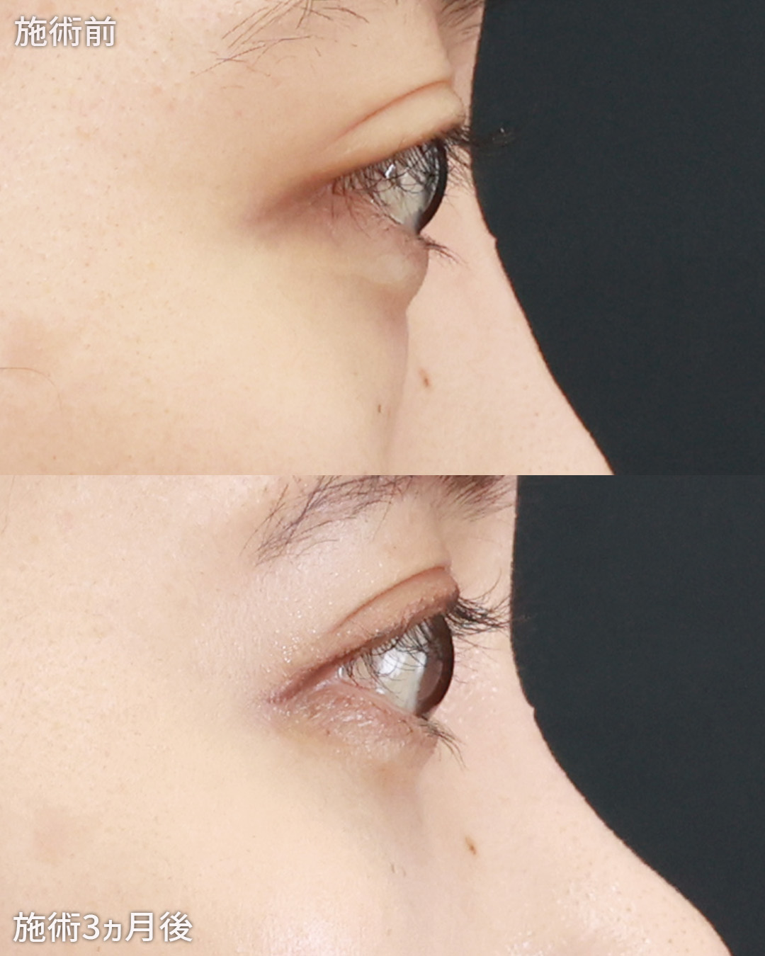 下眼瞼脱脂術（目の下のたるみ取り・目の下の脂肪ふくらみ取り）/顔の脂肪注入(コンデンスリッチフェイス)の症例写真 施術前後 