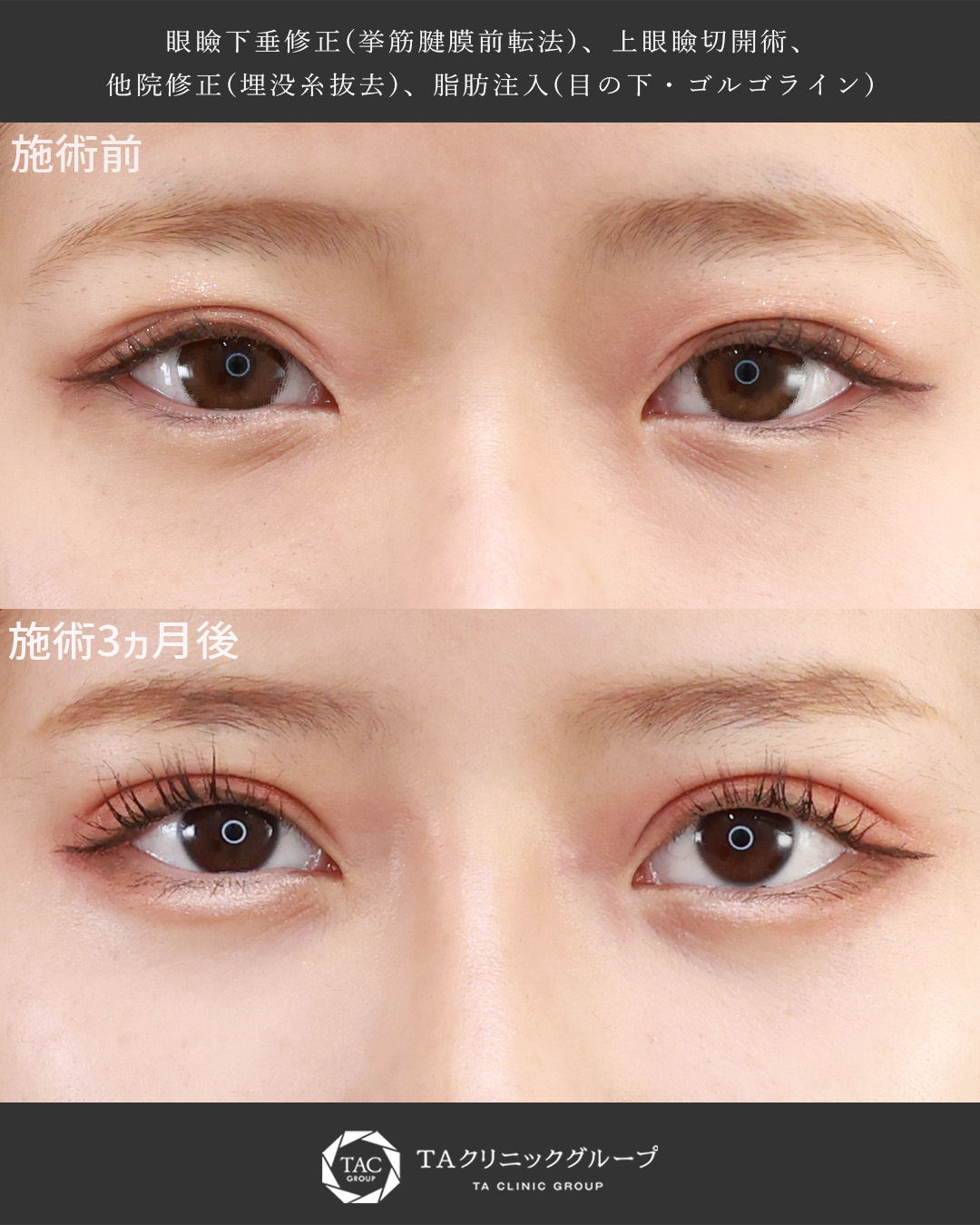 二重ライン安定＆ぱっちり目元に｜20代女性の眼瞼下垂+上眼瞼切開術+他院埋没糸抜去