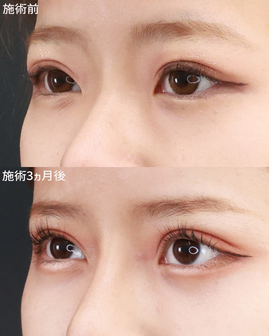 上眼瞼切開術/眼瞼下垂（目つき矯正）/顔の脂肪注入(コンデンスリッチフェイス)の症例写真 施術前後 