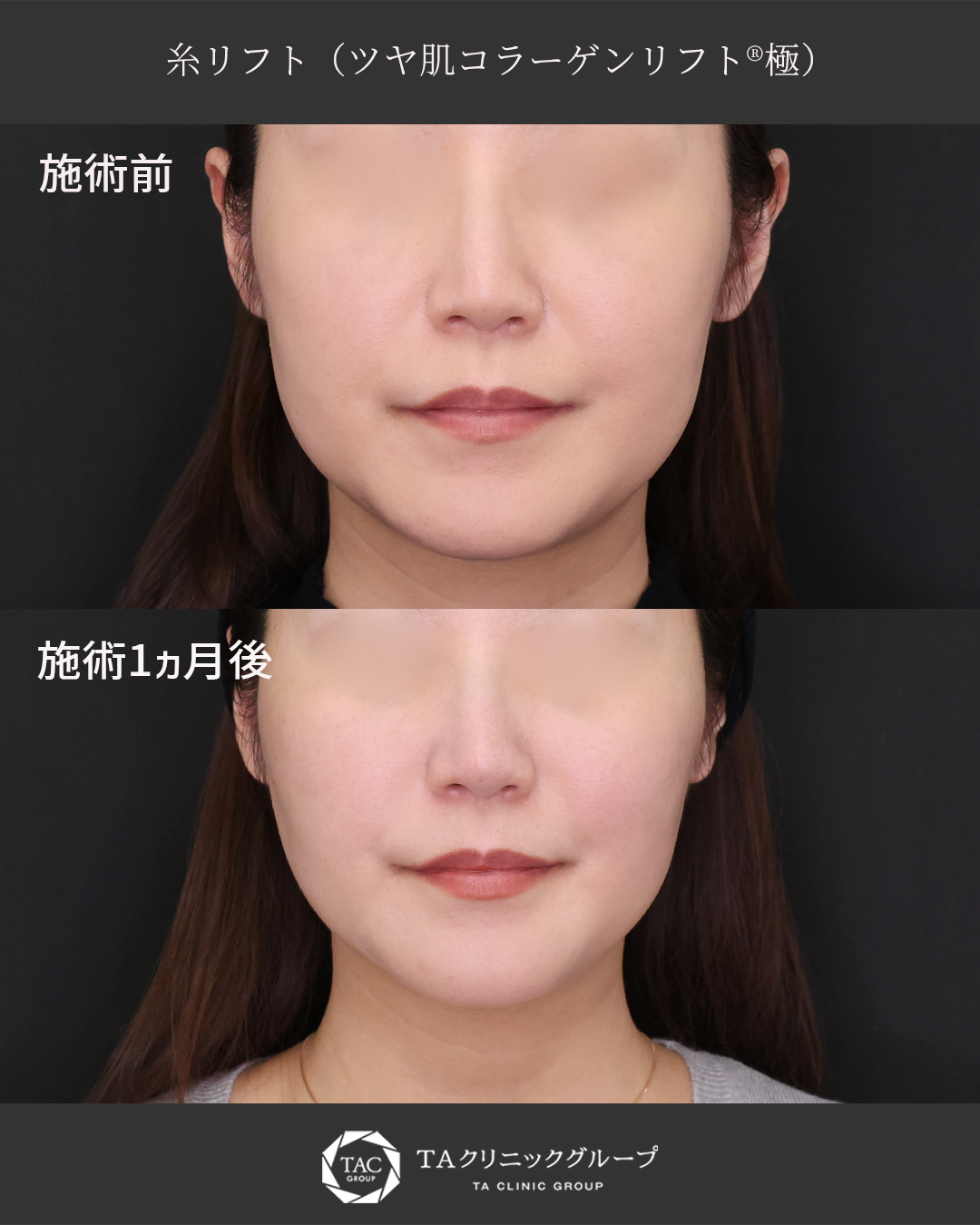 【糸リフト】たるみケアの最適解