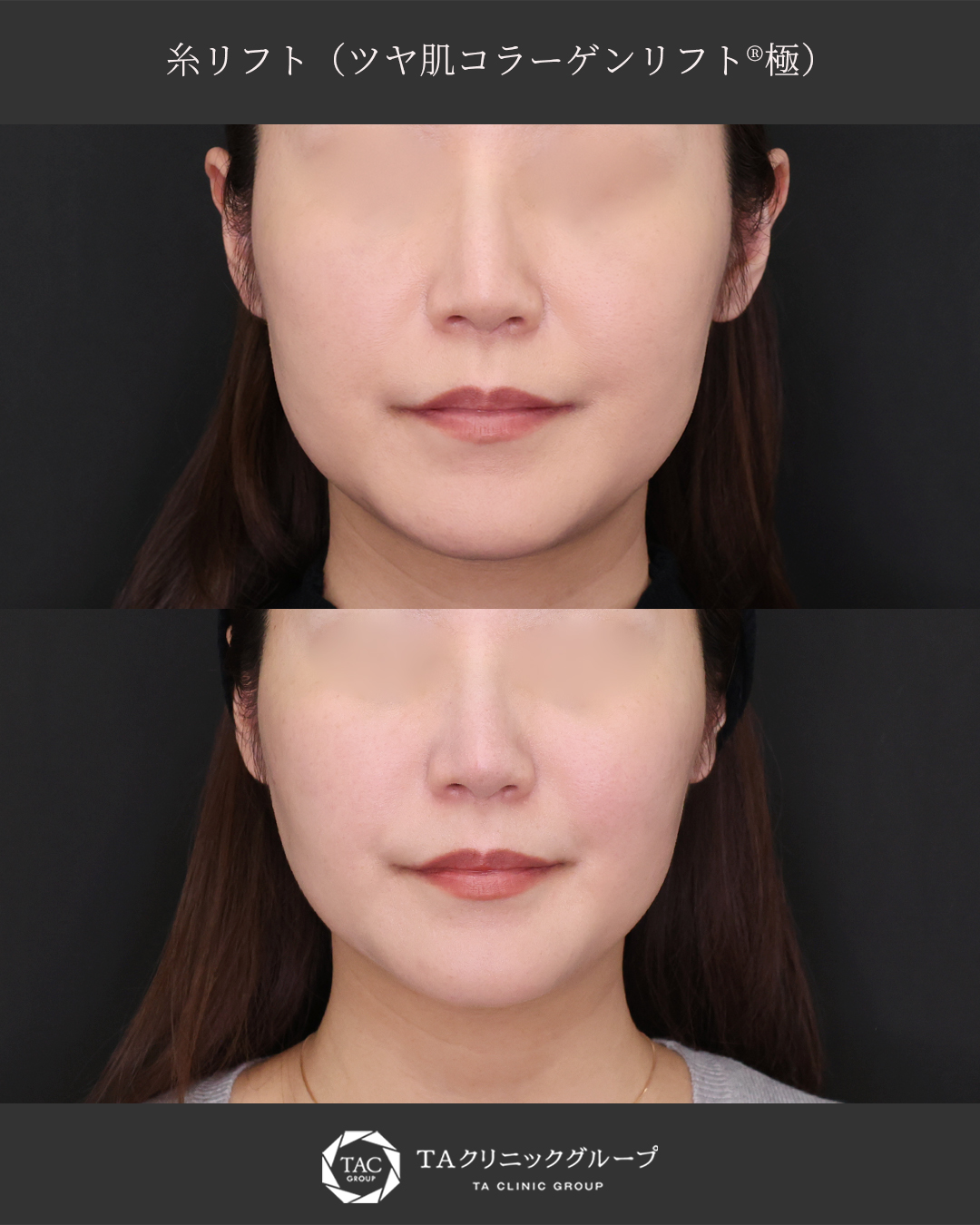 【糸リフト】たるみケアの最適解