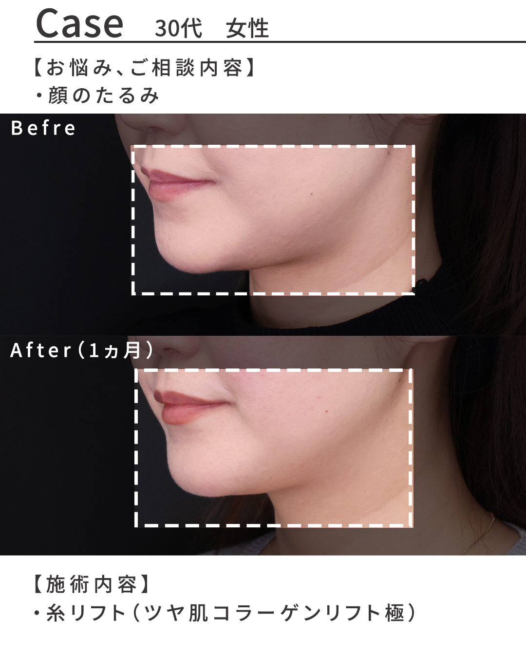 TAC式 ツヤ肌コラーゲンリフト®の症例写真 施術前後 