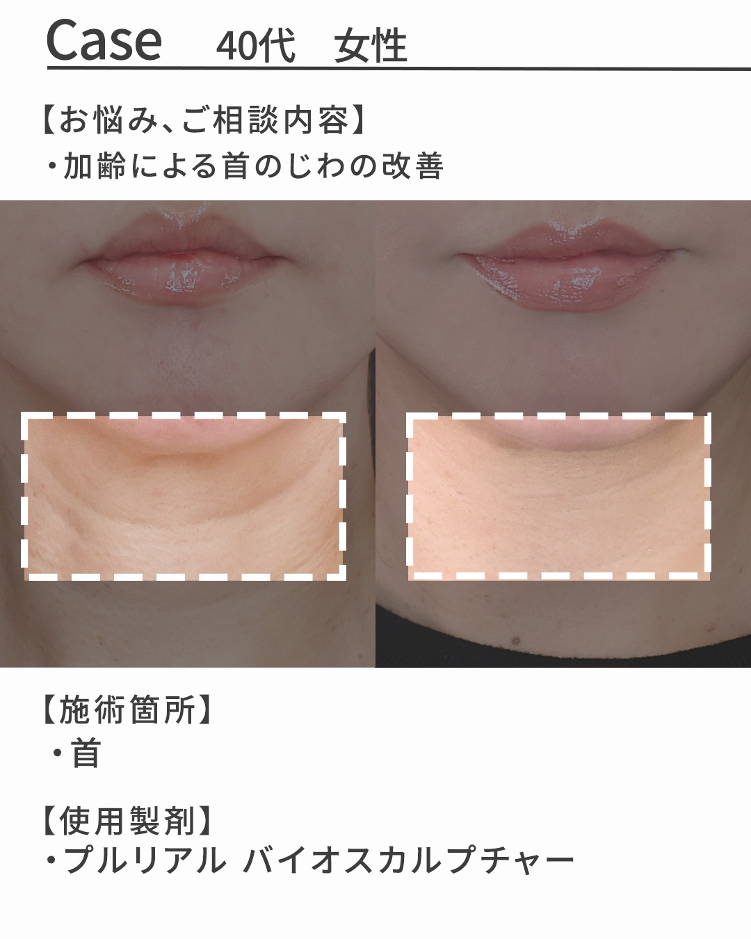 プルリアルデンシファイの症例写真 施術前後 