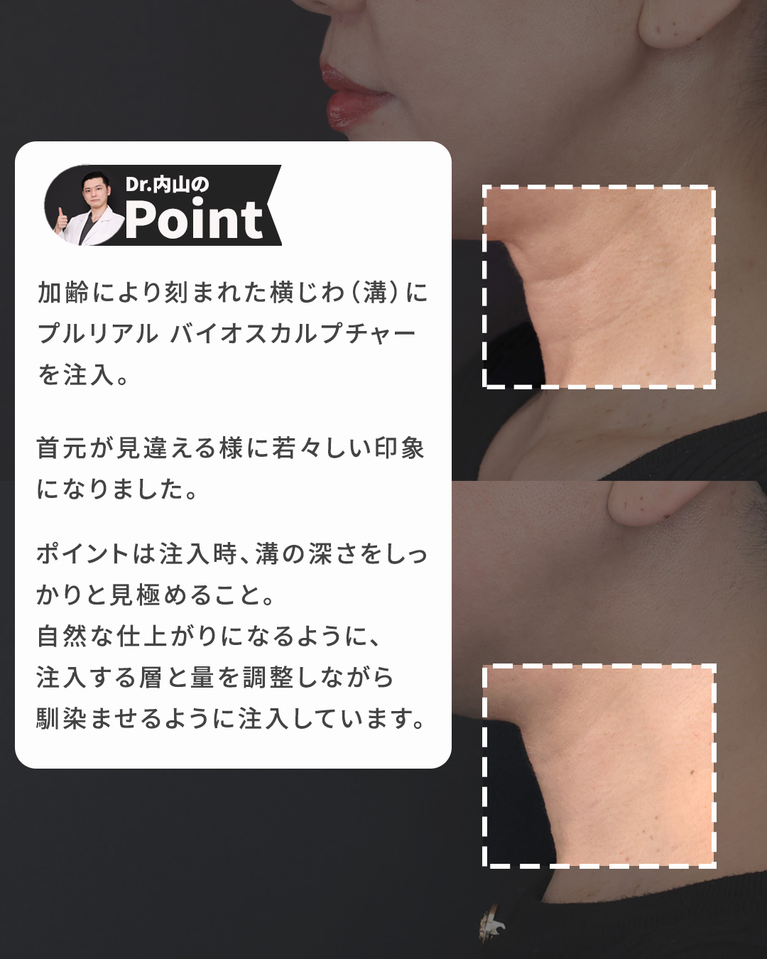 プルリアルデンシファイの症例写真 施術前後 