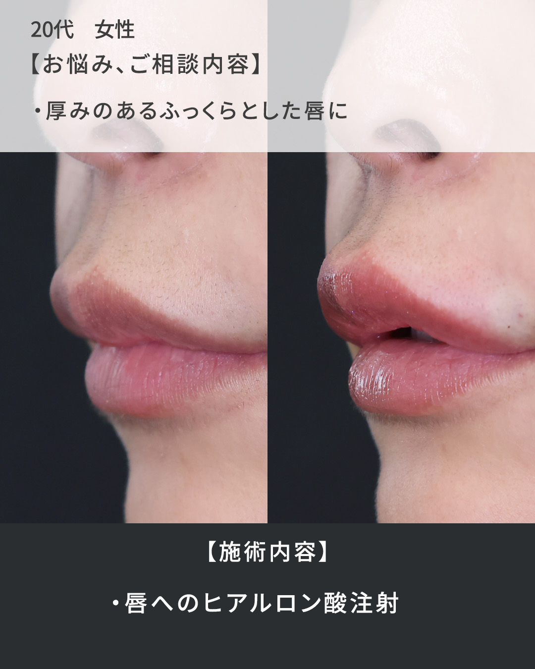 ヒアルロン酸注射：その他の症例写真 施術前後 