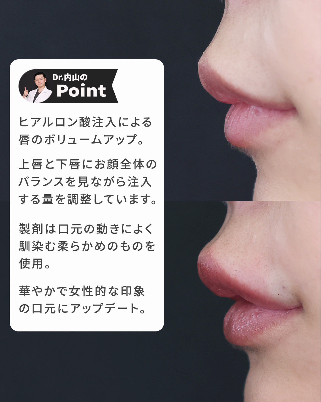 ヒアルロン酸注射：その他の症例写真 施術前後 