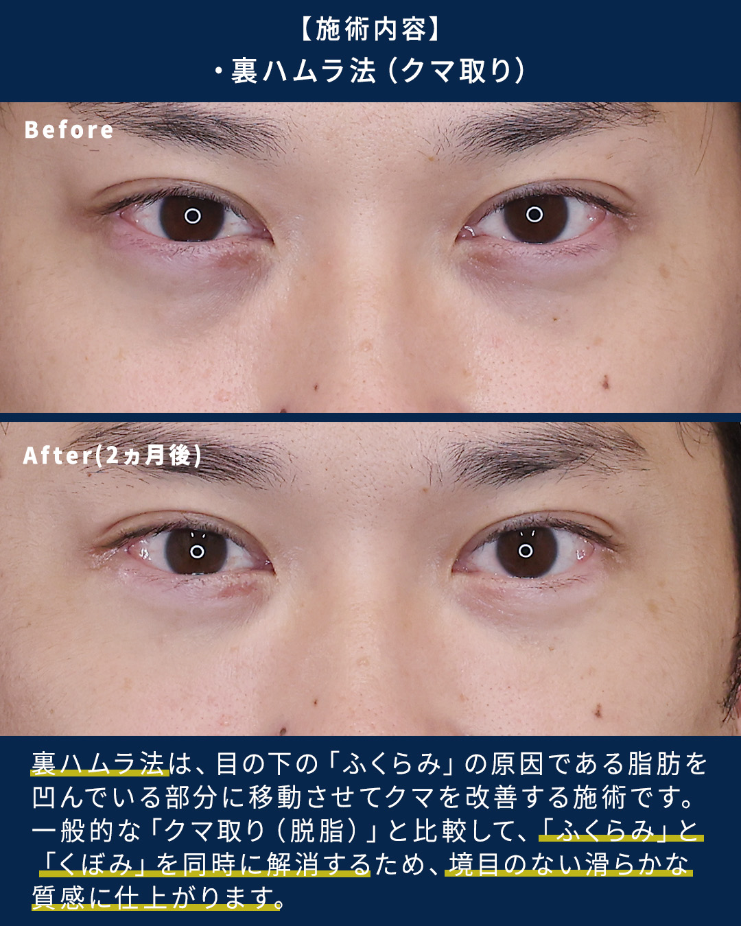 下眼瞼脱脂術（目の下のたるみ取り・目の下の脂肪ふくらみ取り）/下眼瞼切開術（クマ・たるみとり）の症例写真 施術前後 