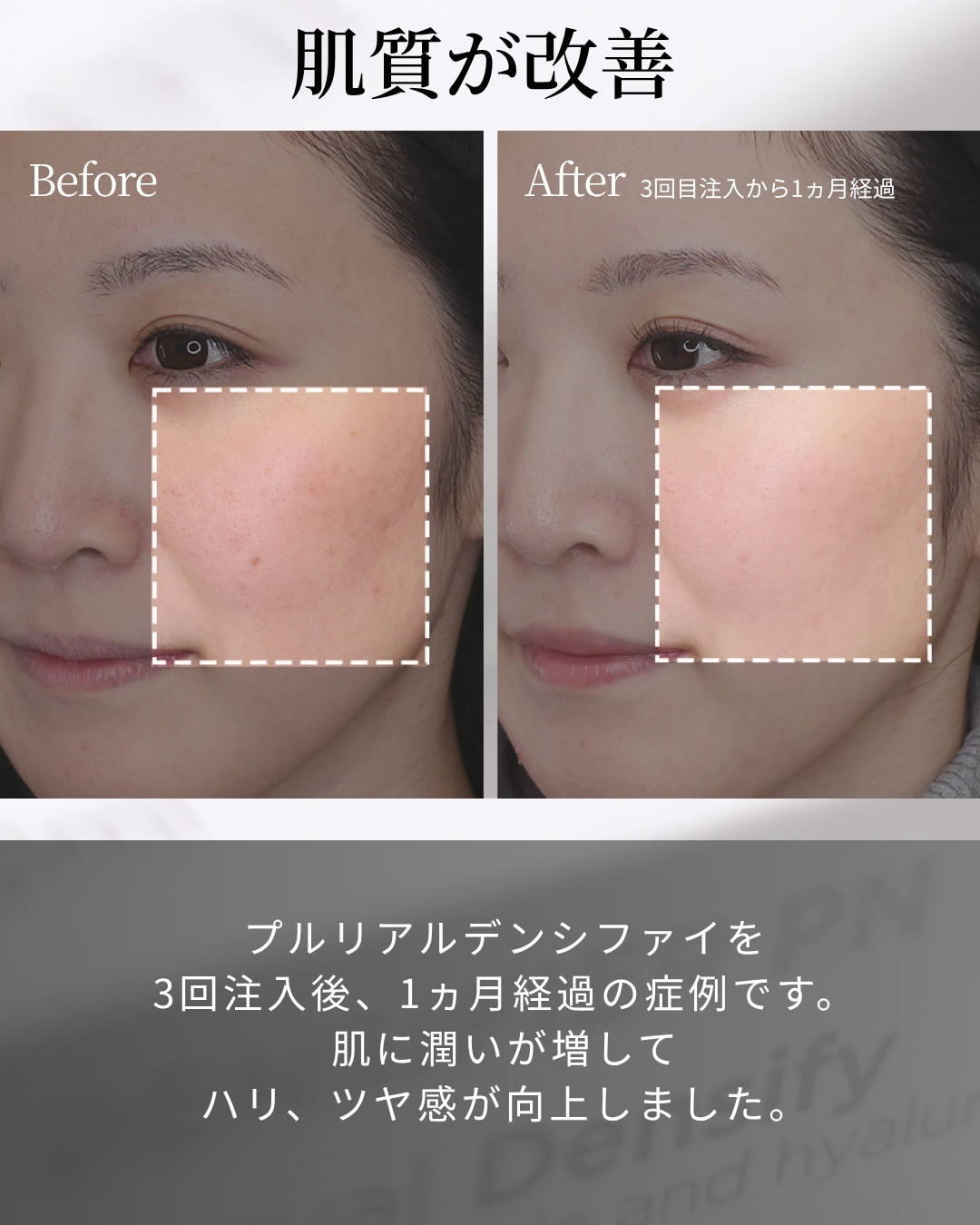 プルリアルデンシファイの症例写真 施術前後 
