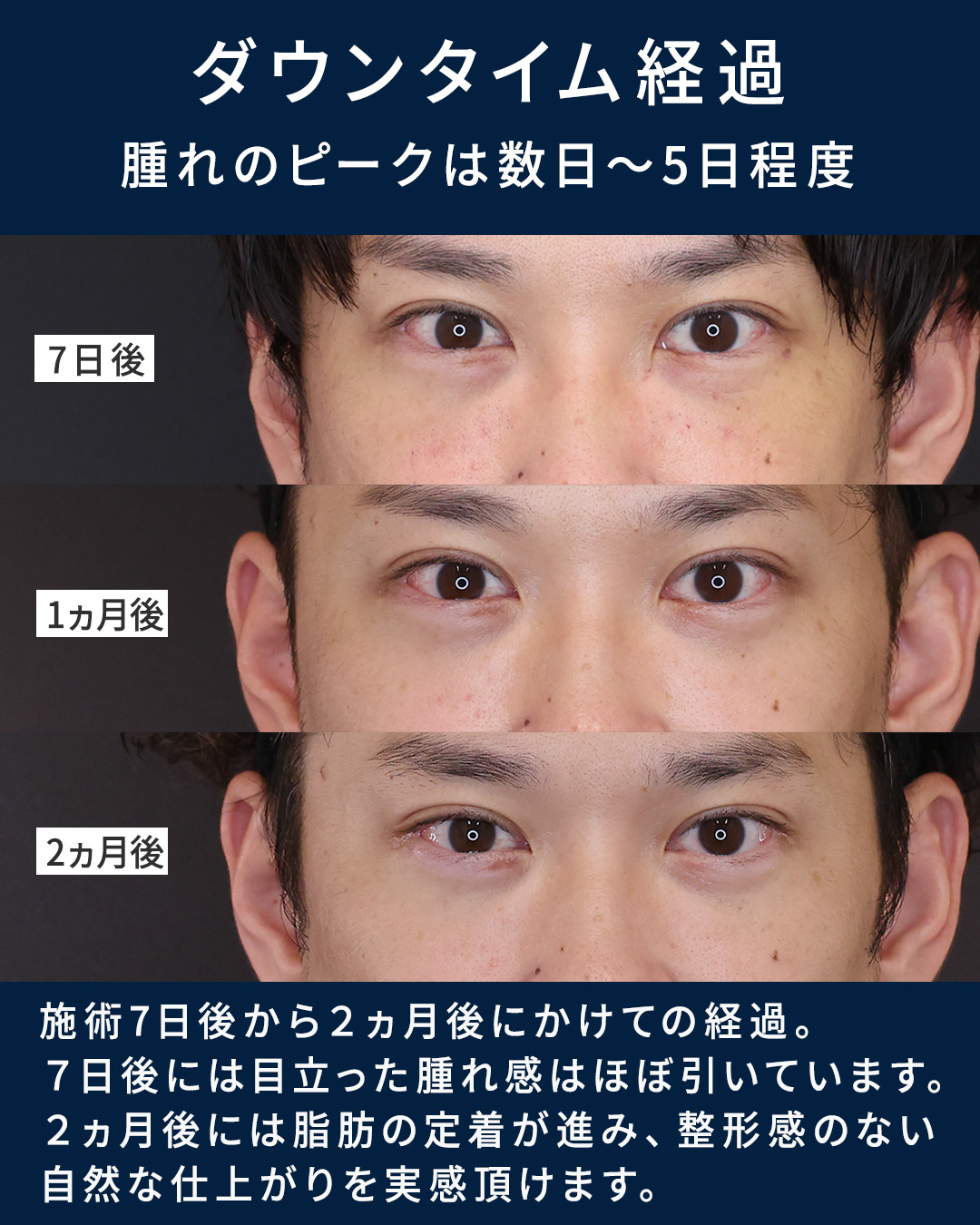 下眼瞼脱脂術（目の下のたるみ取り・目の下の脂肪ふくらみ取り）/下眼瞼切開術（クマ・たるみとり）の症例写真 施術前後 