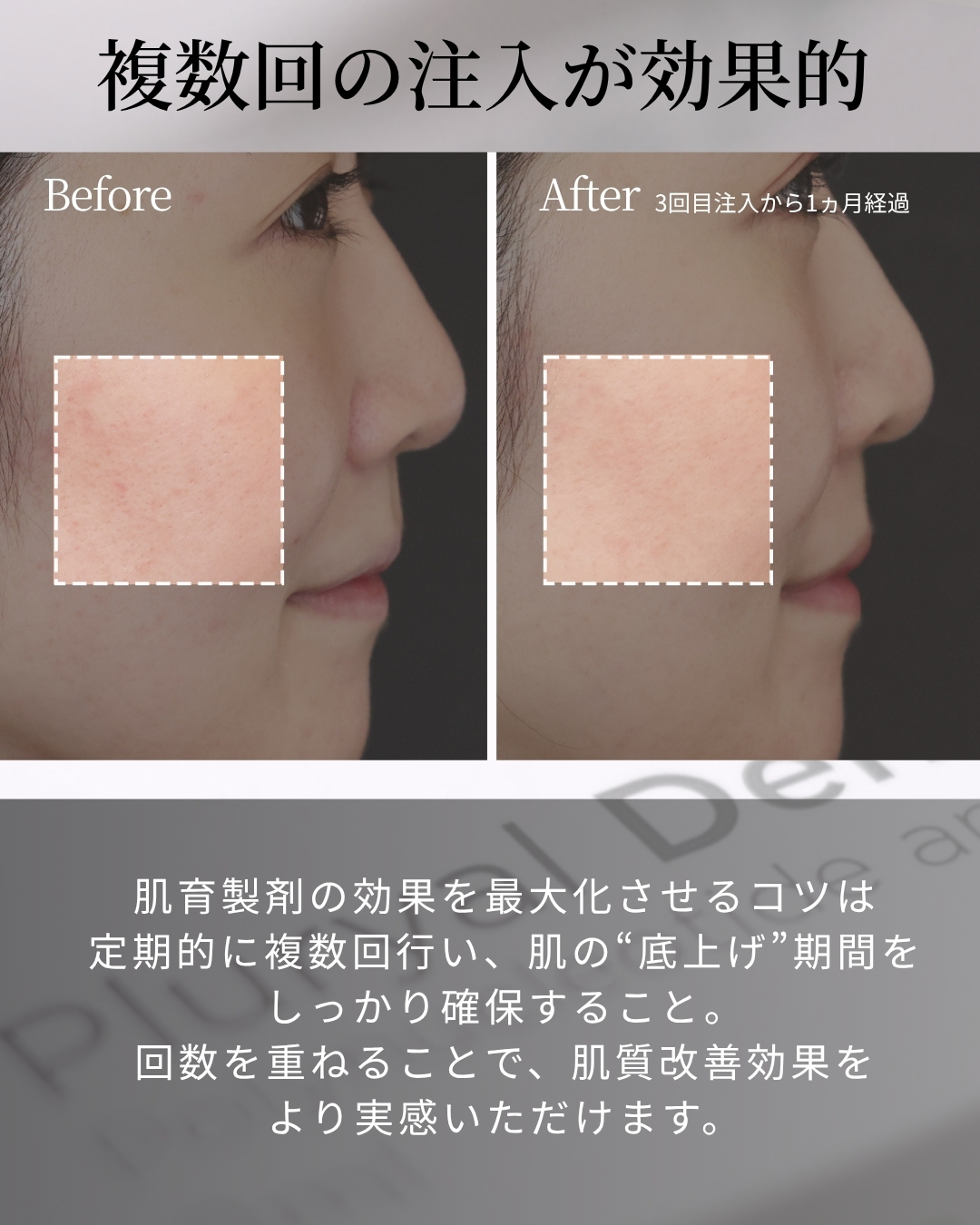 プルリアルデンシファイの症例写真 施術前後 
