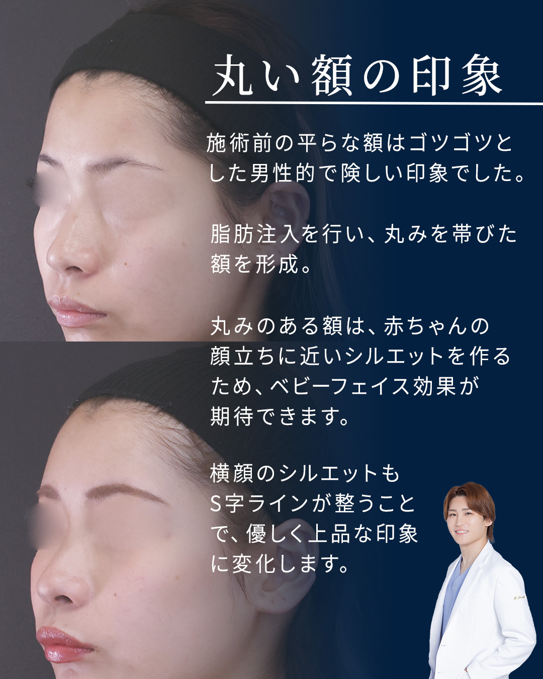 顔の脂肪注入(コンデンスリッチフェイス)の症例写真 施術前後 