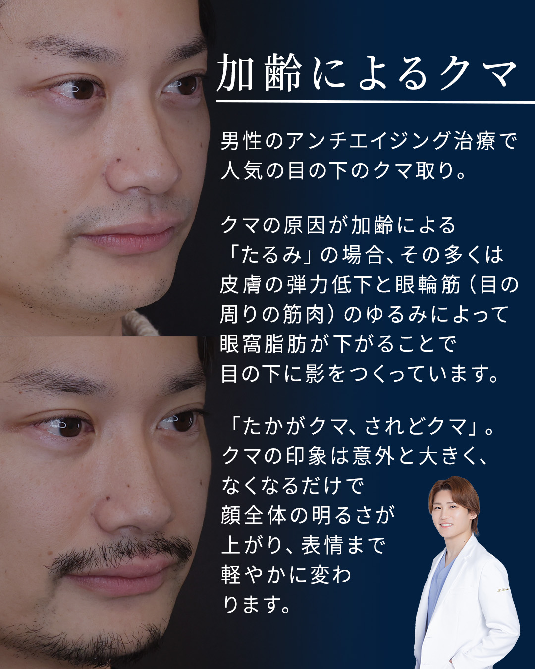 下眼瞼脱脂術（目の下のたるみ取り・目の下の脂肪ふくらみ取り）/下眼瞼切開術（クマ・たるみとり）の症例写真 施術前後 