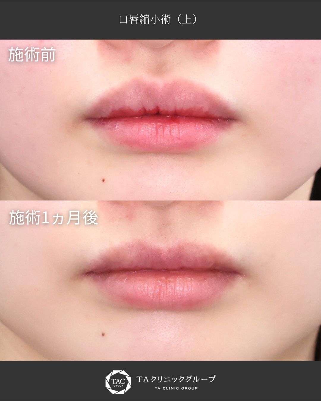 【口唇縮小術】｜上口唇の厚み改善で唇のバランスを整える◎
