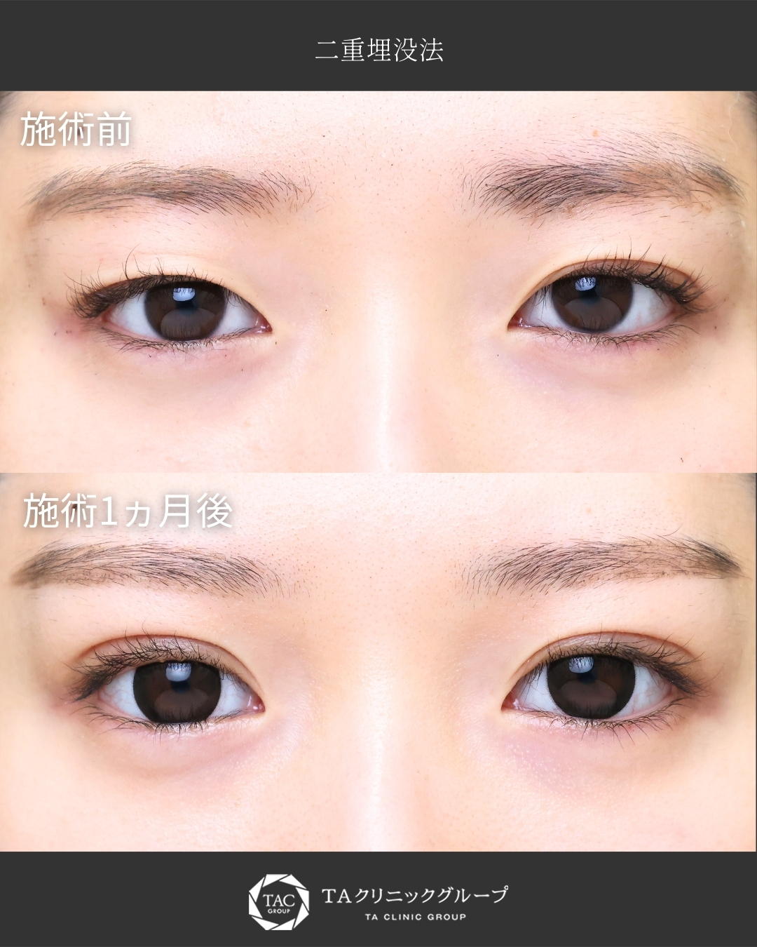 【二重埋没法】｜アイテープで作っている幅を二重埋没で再現