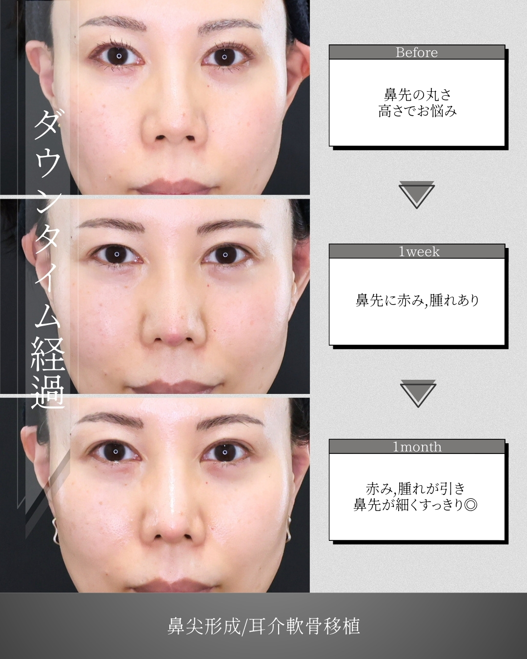 鼻先軟骨移植/鼻尖形成・鼻尖縮小の症例写真 施術前後 