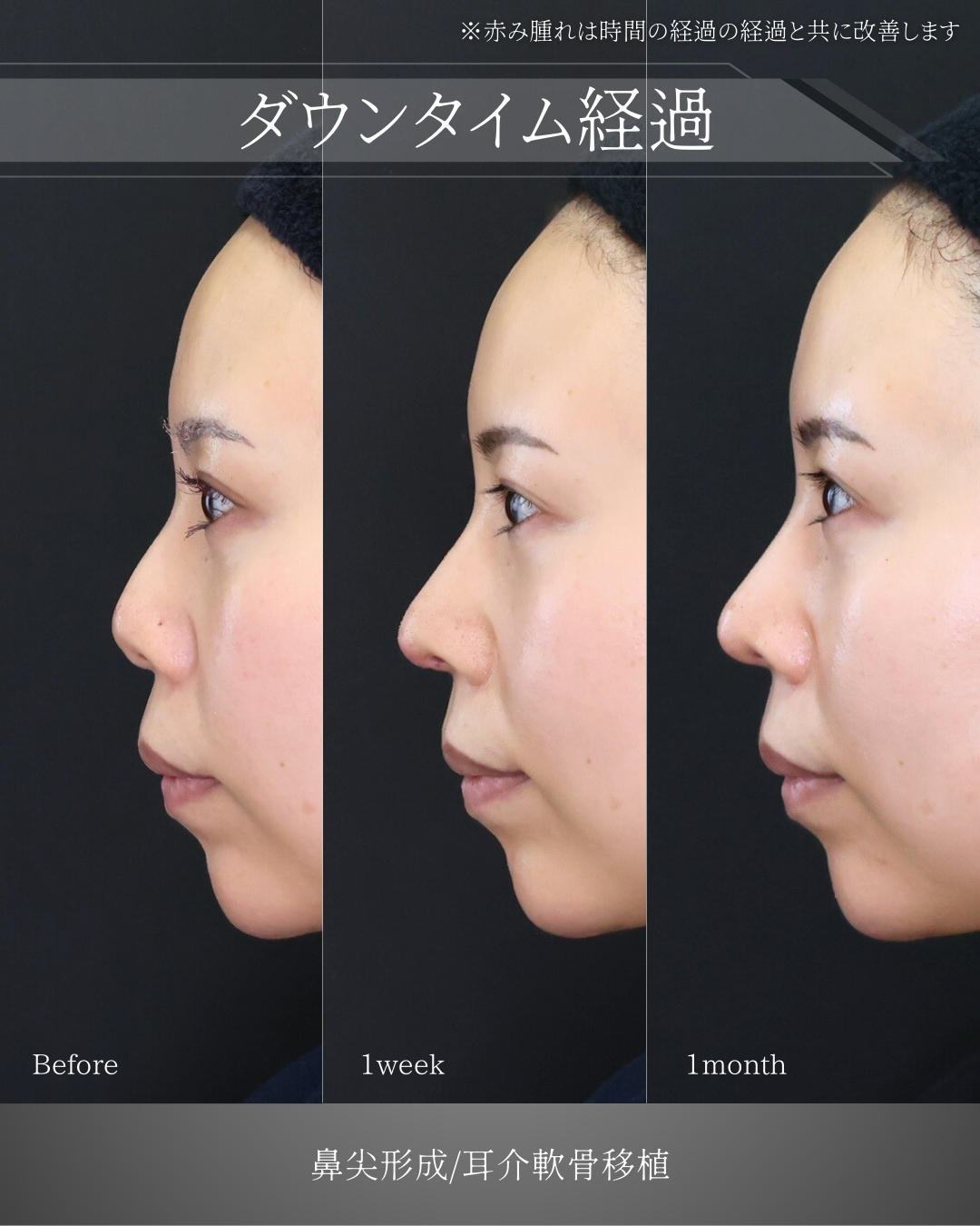 鼻先軟骨移植/鼻尖形成・鼻尖縮小の症例写真 施術前後 