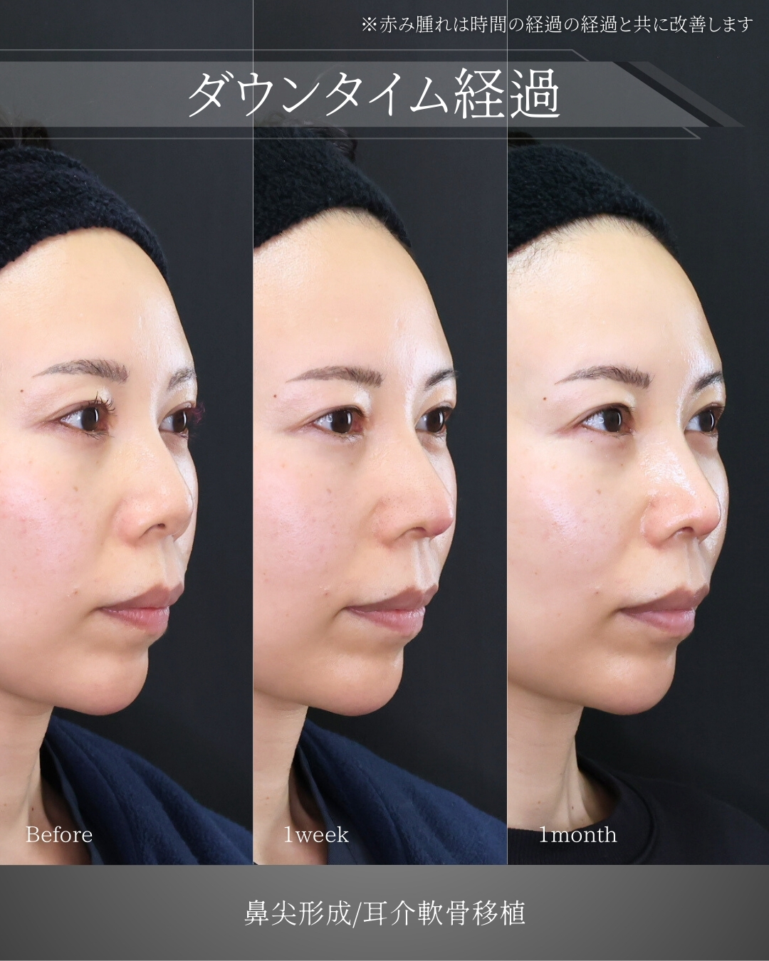 鼻先軟骨移植/鼻尖形成・鼻尖縮小の症例写真 施術前後 