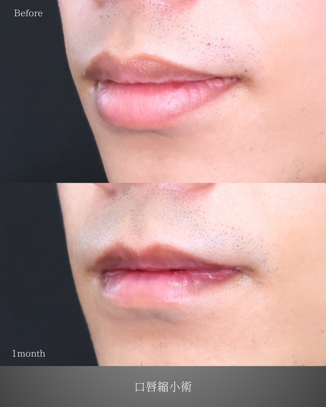 口唇縮小術の症例写真 施術前後 
