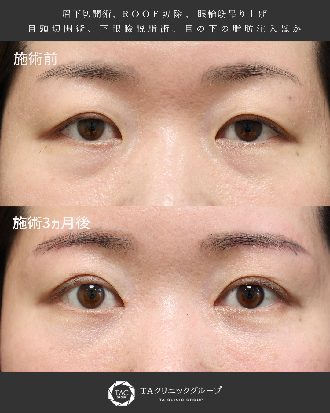 【目元複合施術】たるみ・クマを改善し明るい目元へ