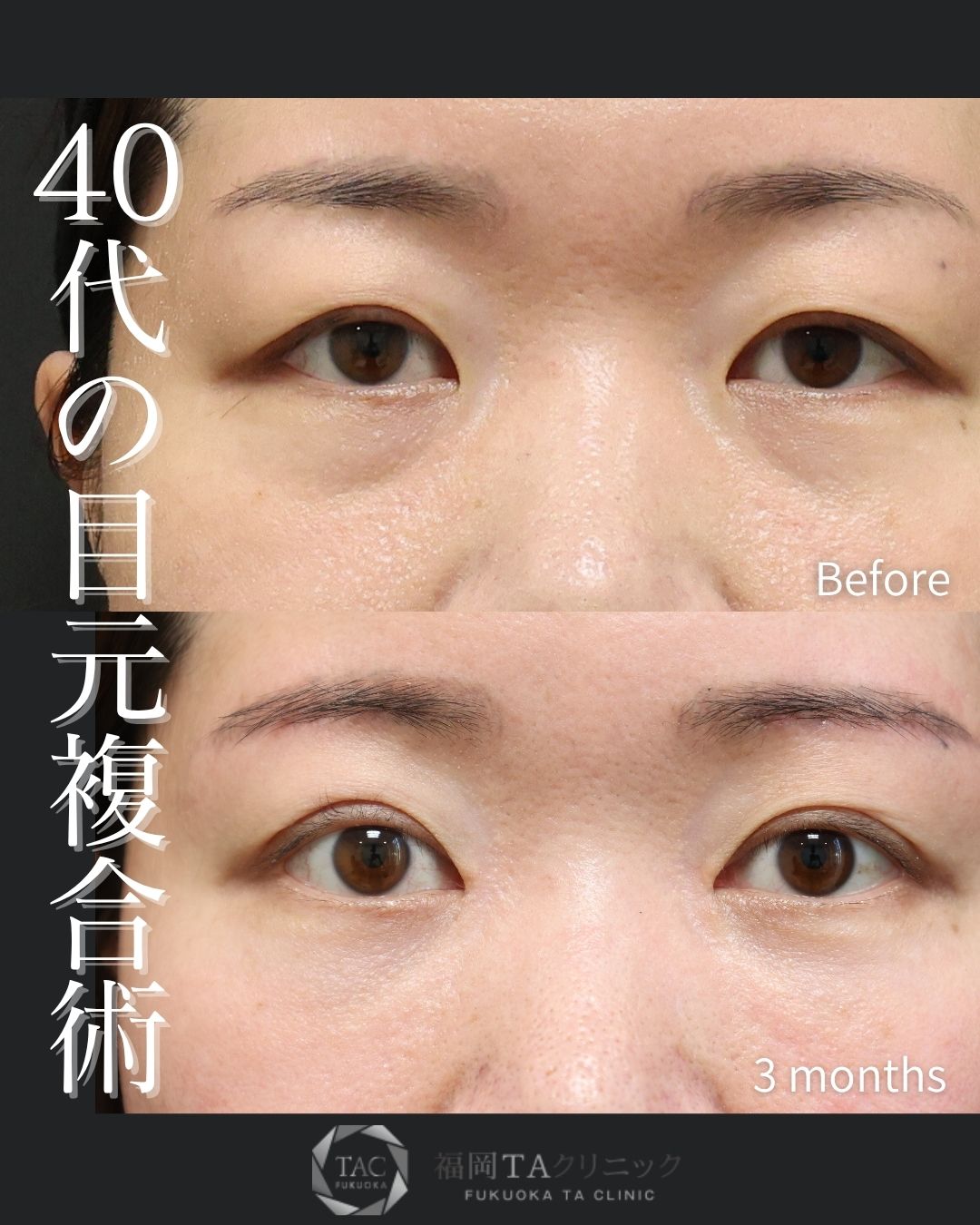 眉毛下切開術/目頭切開術/下眼瞼脱脂術（目の下のたるみ取り・目の下の脂肪ふくらみ取り）の症例写真 施術前後 