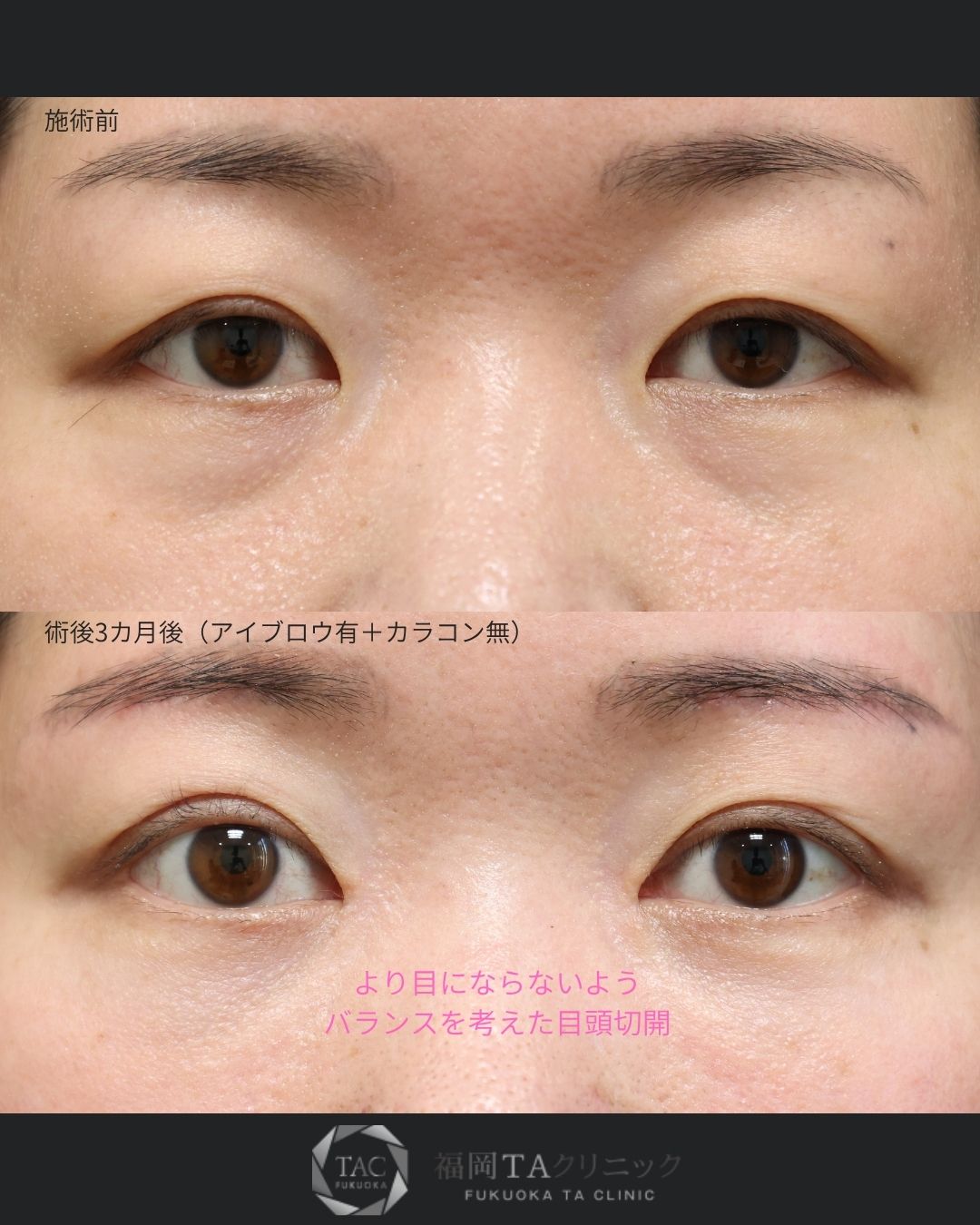 眉毛下切開術/目頭切開術/下眼瞼脱脂術（目の下のたるみ取り・目の下の脂肪ふくらみ取り）の症例写真 施術前後 