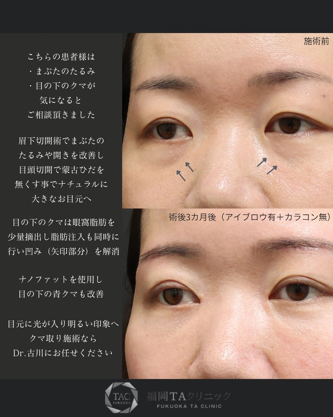 眉毛下切開術/目頭切開術/下眼瞼脱脂術（目の下のたるみ取り・目の下の脂肪ふくらみ取り）の症例写真 施術前後 