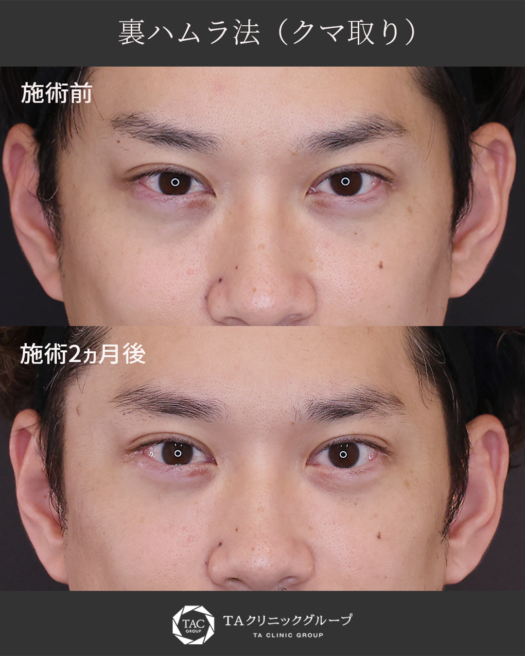 【裏ハムラ法】目の下のたるみを解消