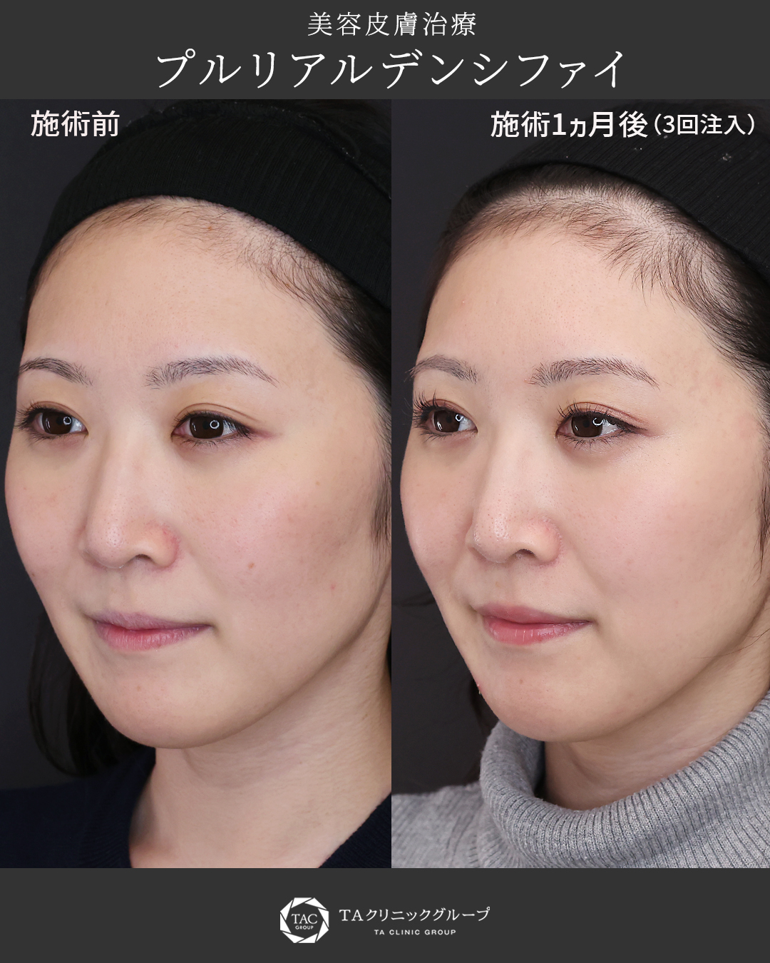 【プルリアルデンシファイ】ハリツヤ効果最大化のコツ