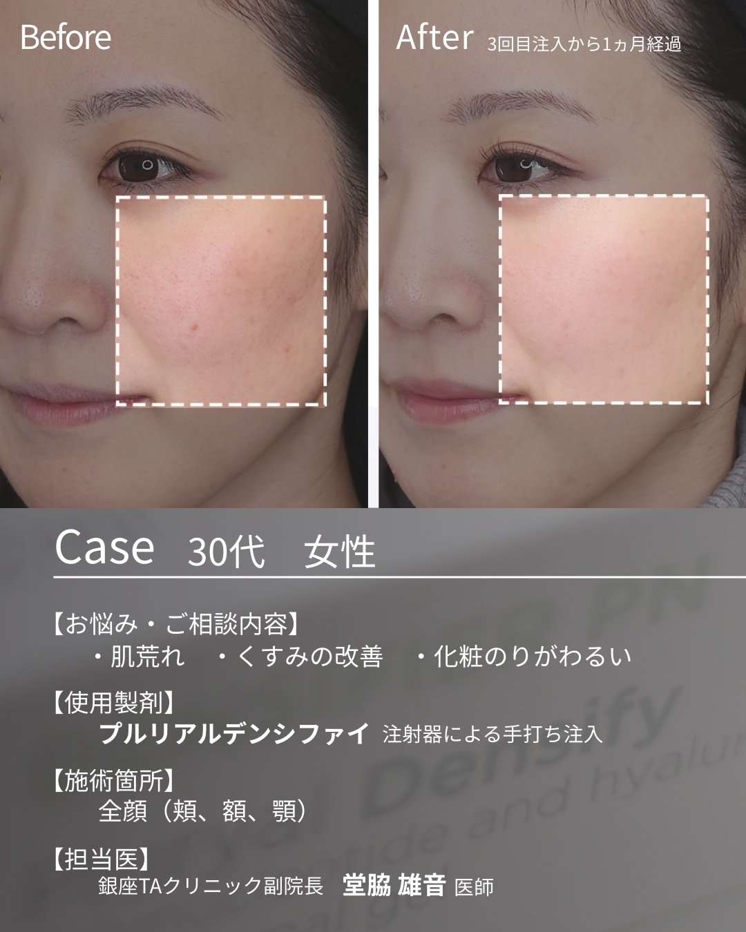 プルリアルデンシファイの症例写真 施術前後 