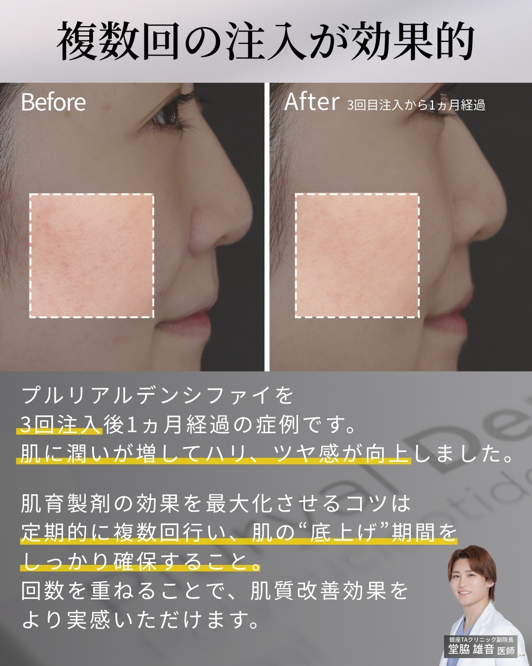 プルリアルデンシファイの症例写真 施術前後 