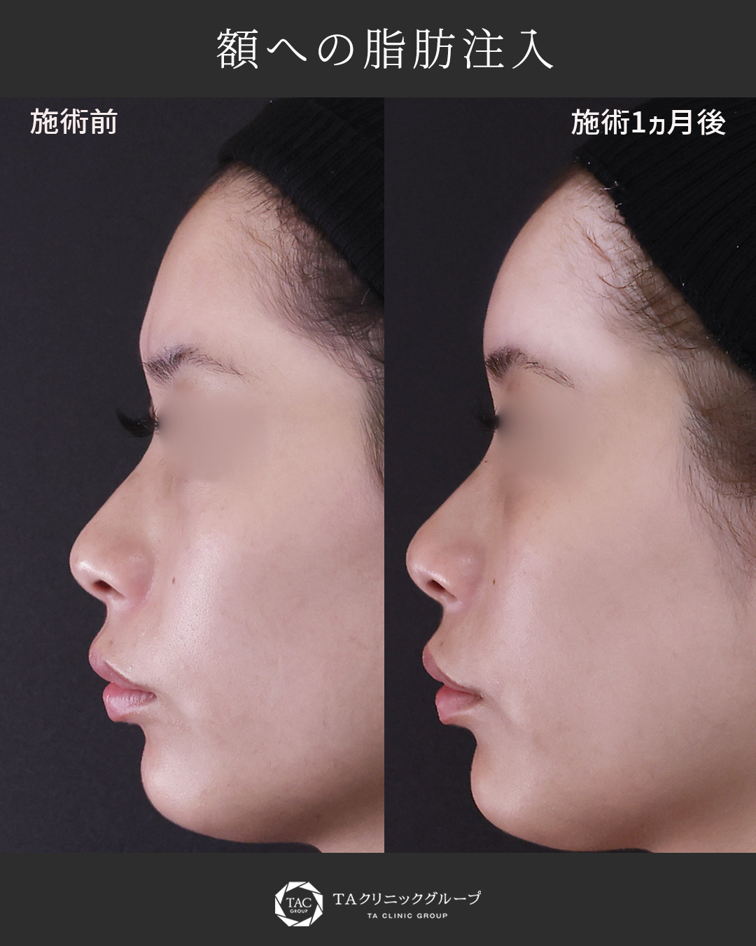 【丸い額形成】余分な脂肪でゴツゴツ感改善