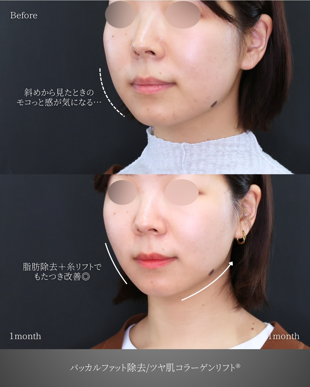 バッカルファット除去/TAC式 ツヤ肌コラーゲンリフト®の症例写真 施術前後 