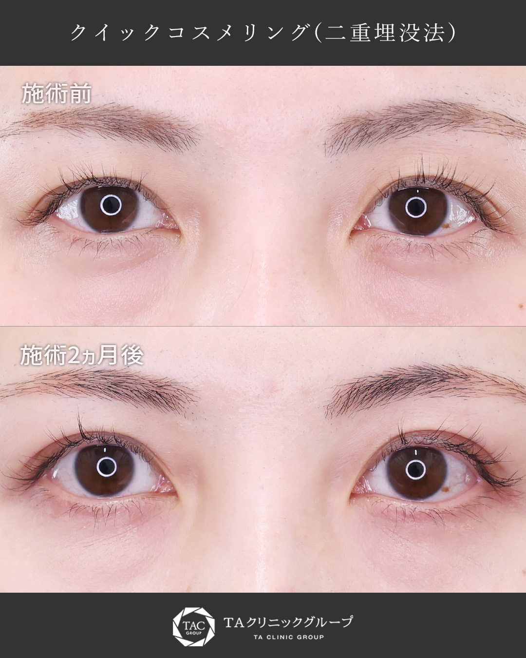 「二重が狭くなった…」30代女性のまぶたのたるみを自然に改善｜バレにくい埋没法