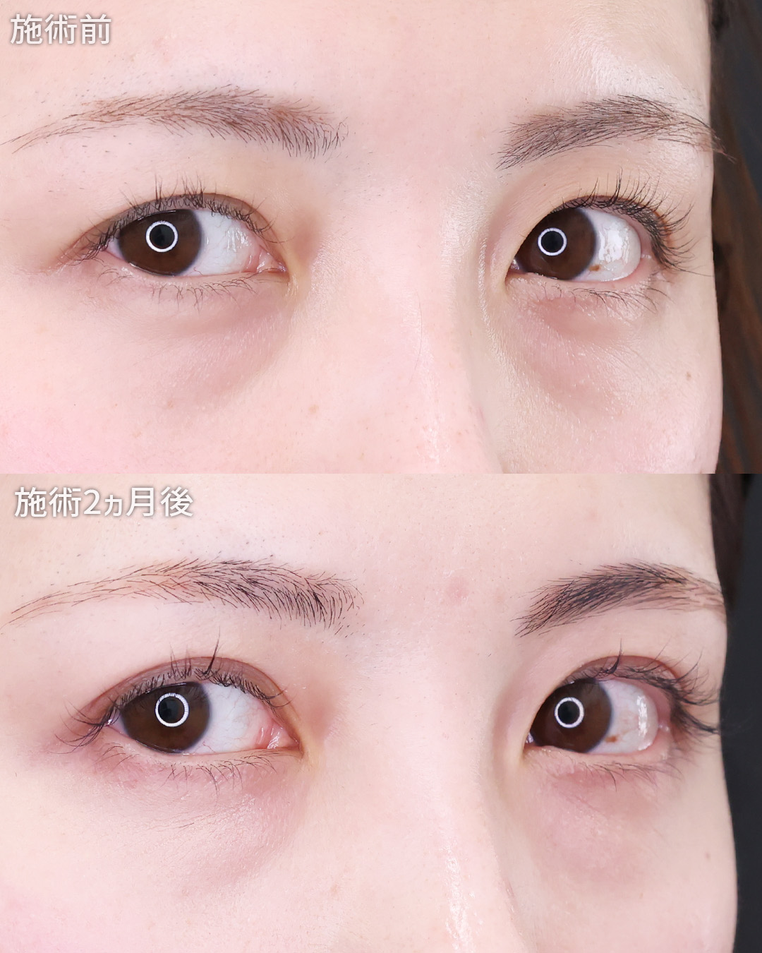 クイックコスメリングの症例写真 施術前後 