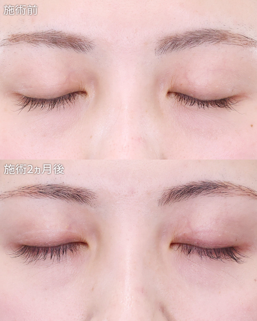 クイックコスメリングの症例写真 施術前後 