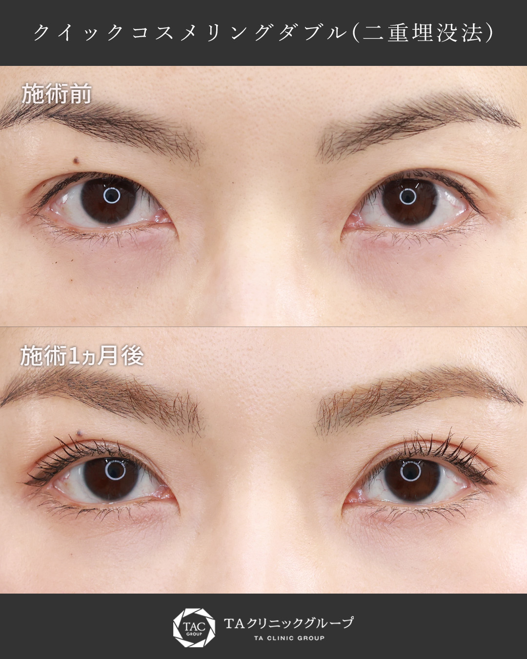 クイックコスメリングの症例写真 施術前後 