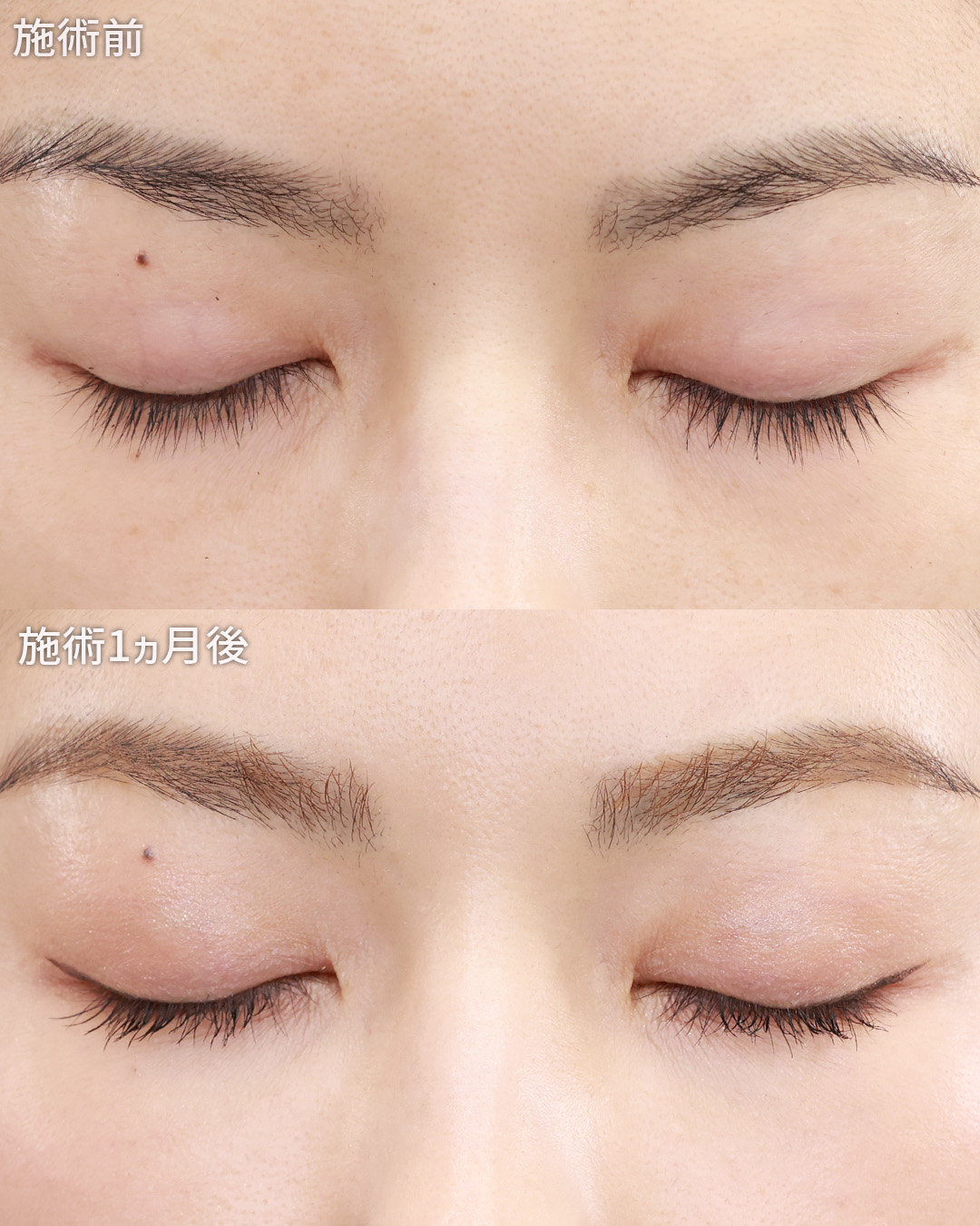 クイックコスメリングの症例写真 施術前後 