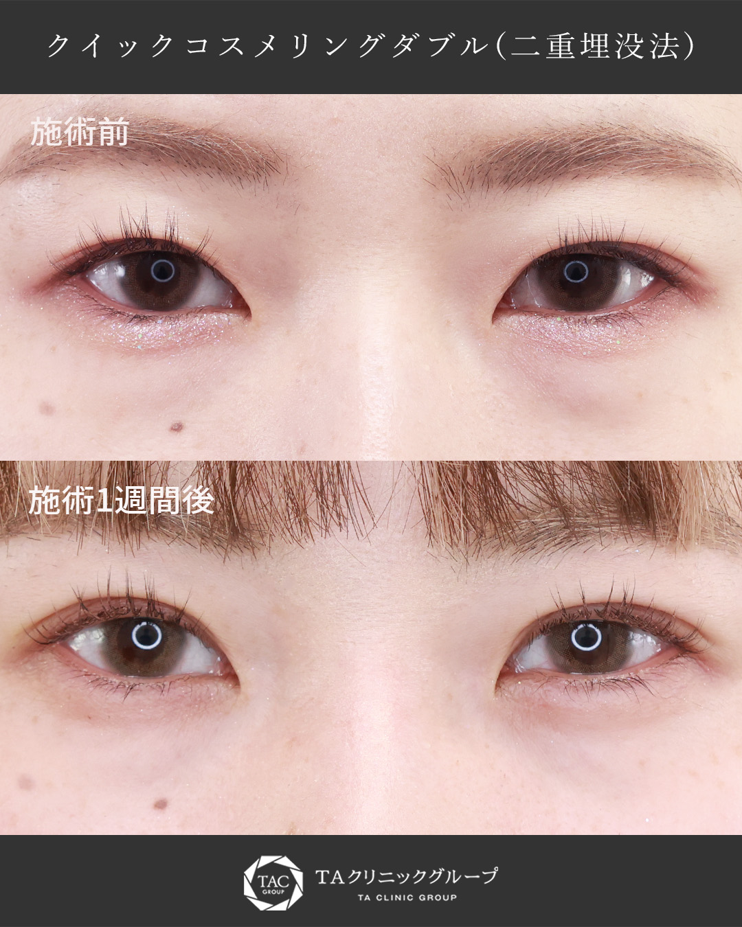 クイックコスメリングの症例写真 施術前後 