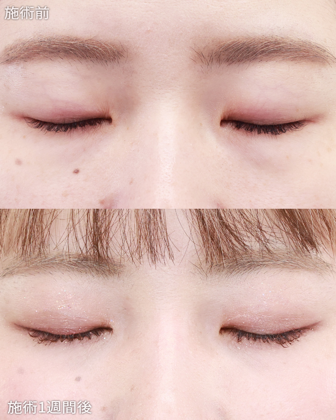 クイックコスメリングの症例写真 施術前後 