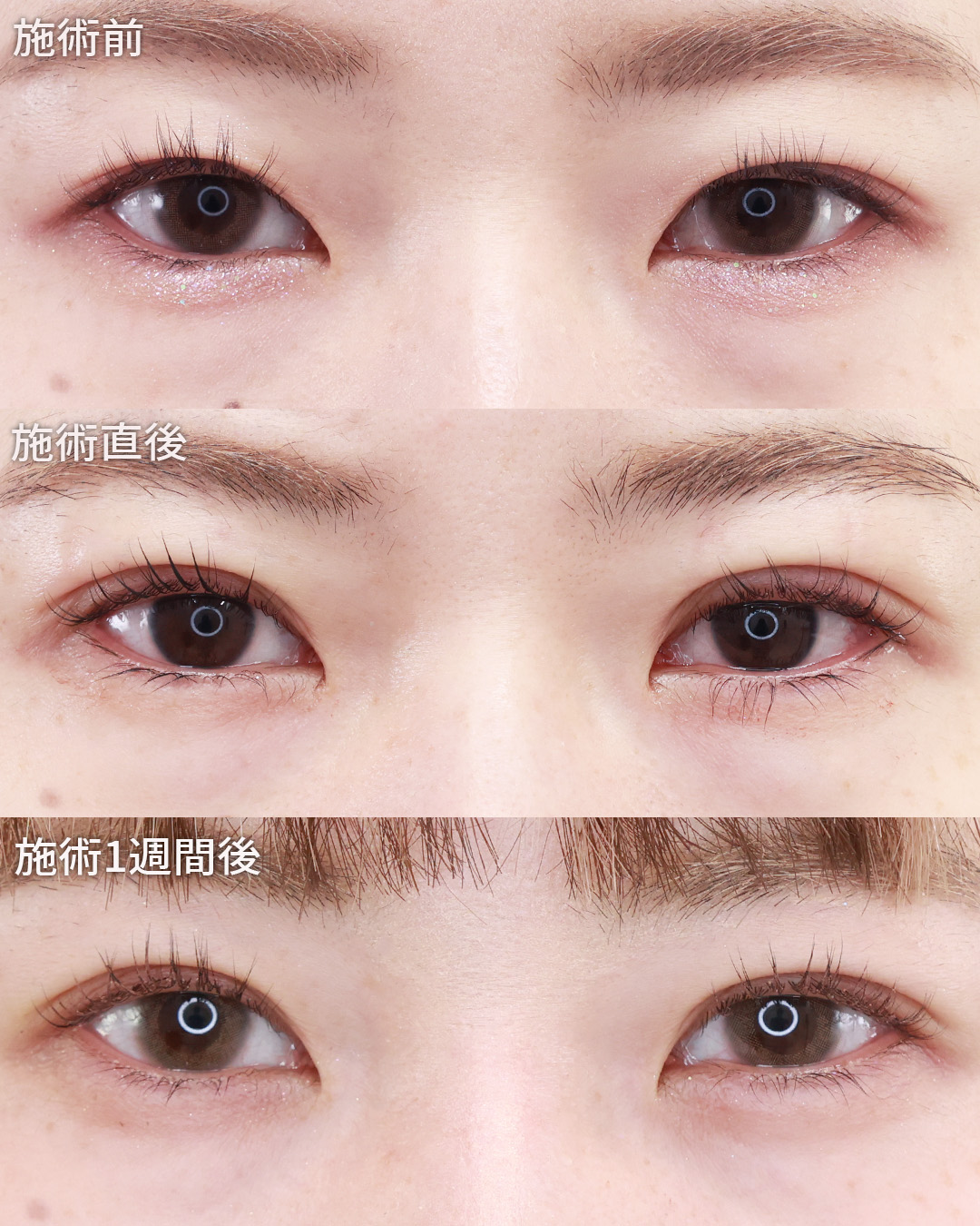 クイックコスメリングの症例写真 施術前後 