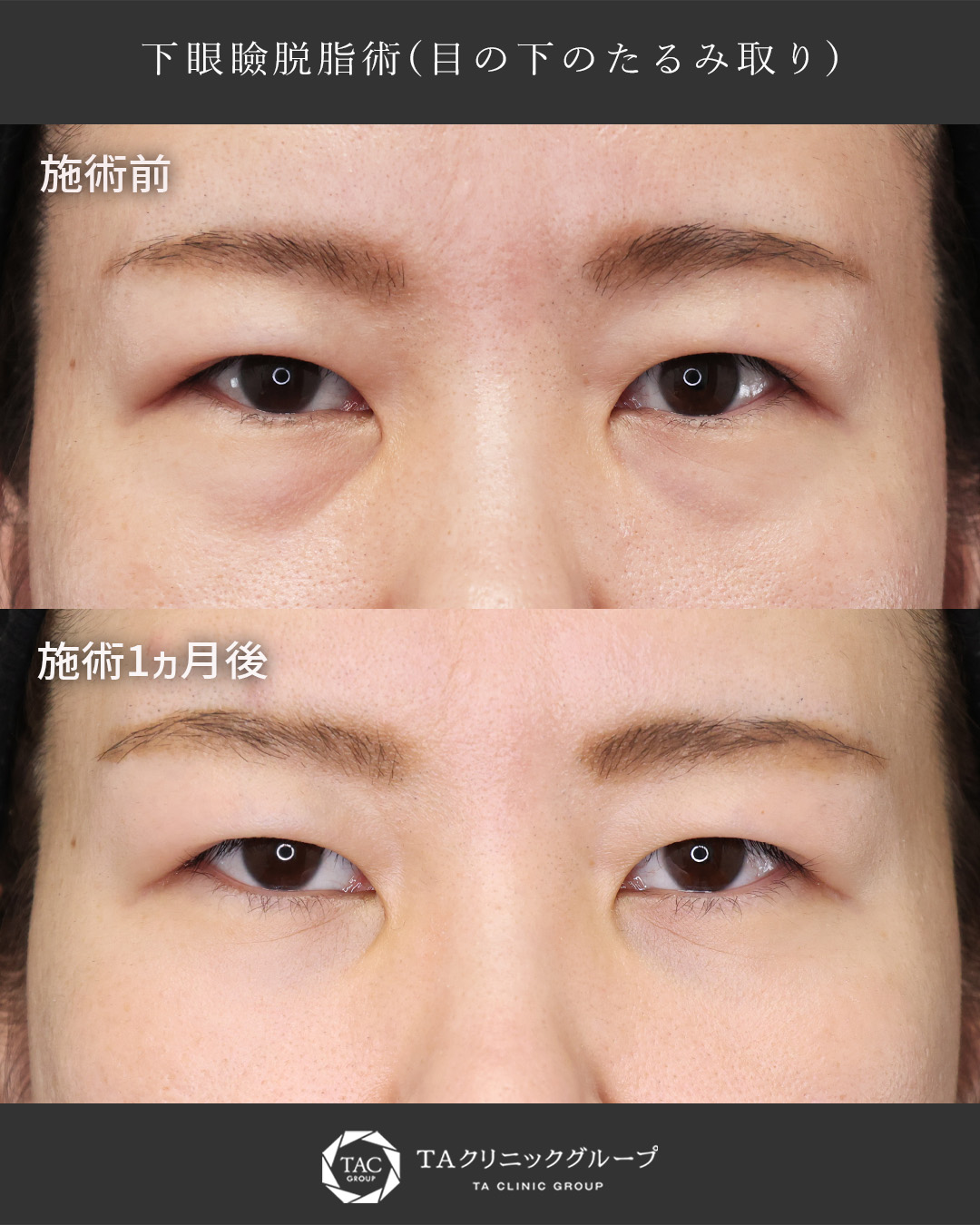 【クマ取り】疲れ顔解消でスッキリとしたお目元へ