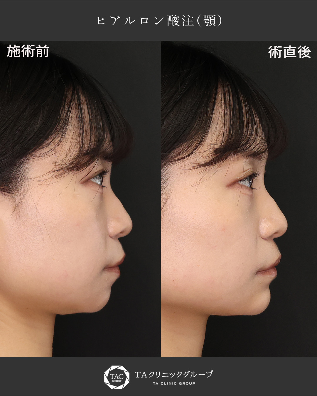 顎ヒアルロン酸で目指す横顔美人