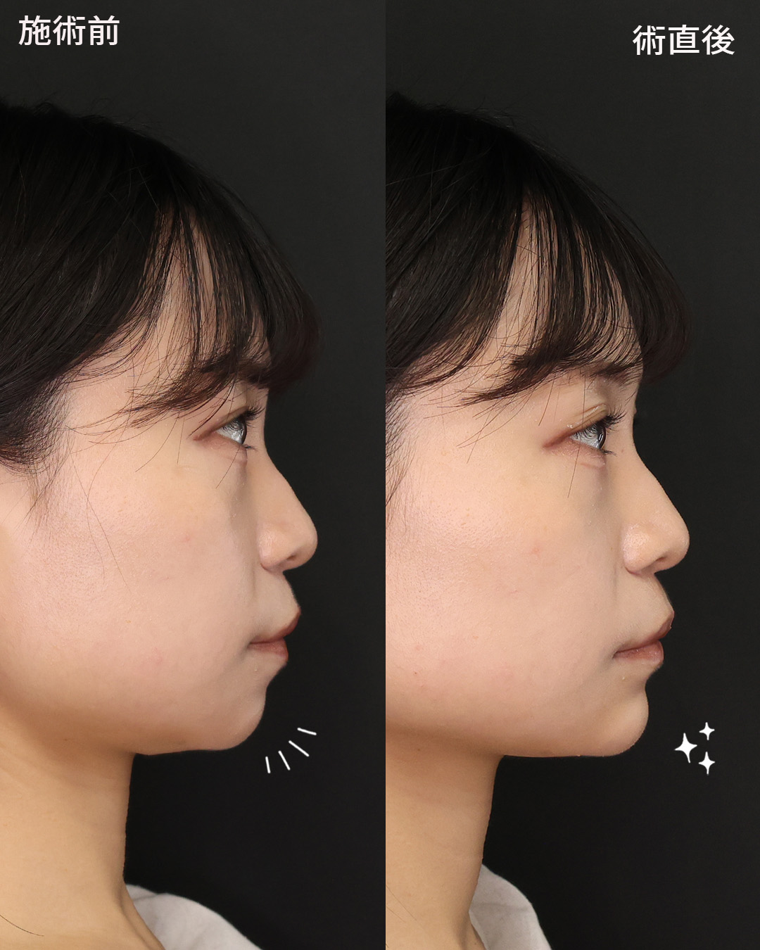 顎のヒアルロン酸注射の症例写真 施術前後 