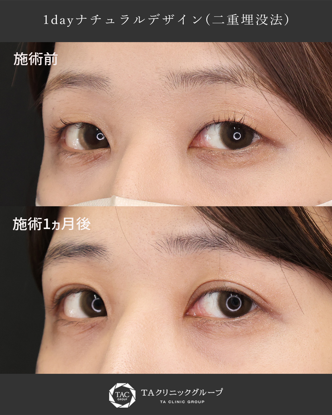 【二重埋没法】整形感0のナチュラルな二重へ